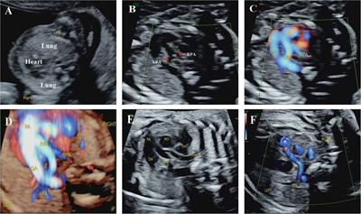 Anomalous origin of the fetal pulmonary artery